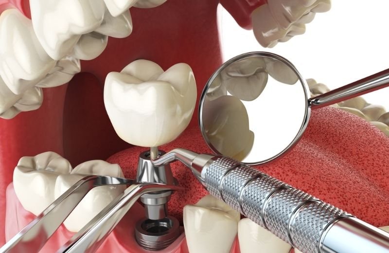 zahnimplantat türkei kosten